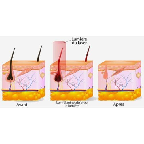 Épilateur à Lumière Pulsée Intense Ipl 999 Flashs Visage